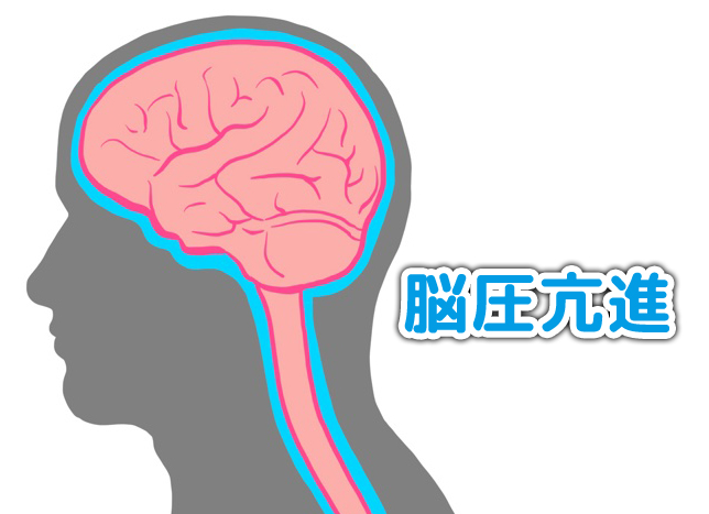 脳圧亢進